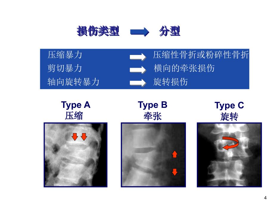 胸腰椎骨折ppt课件_第4页