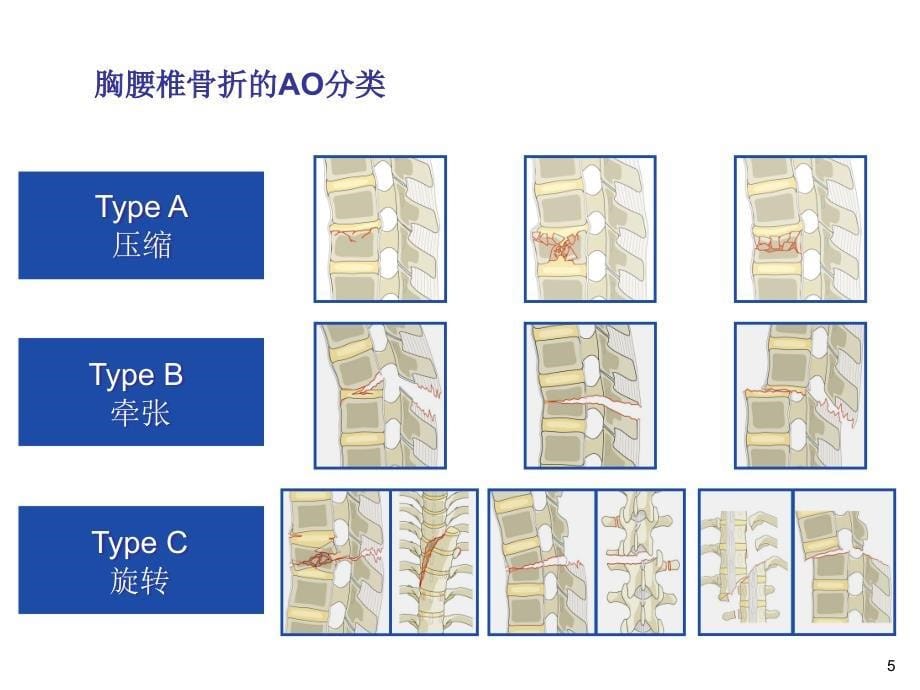 胸腰椎骨折ppt课件_第5页