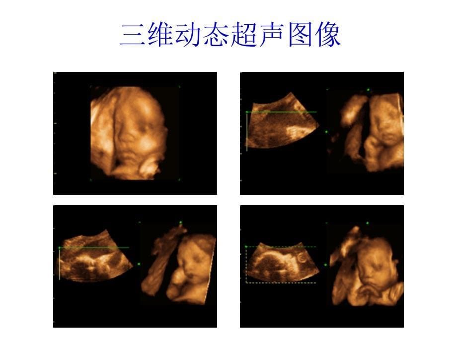 超声波-超声诊断仪的物理原理_第5页