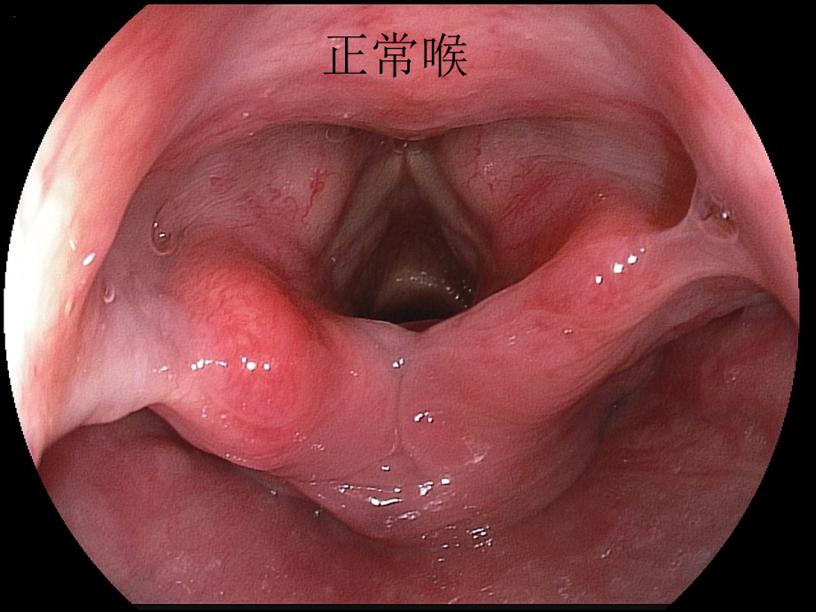 正常胃镜图片及常见病变_第2页