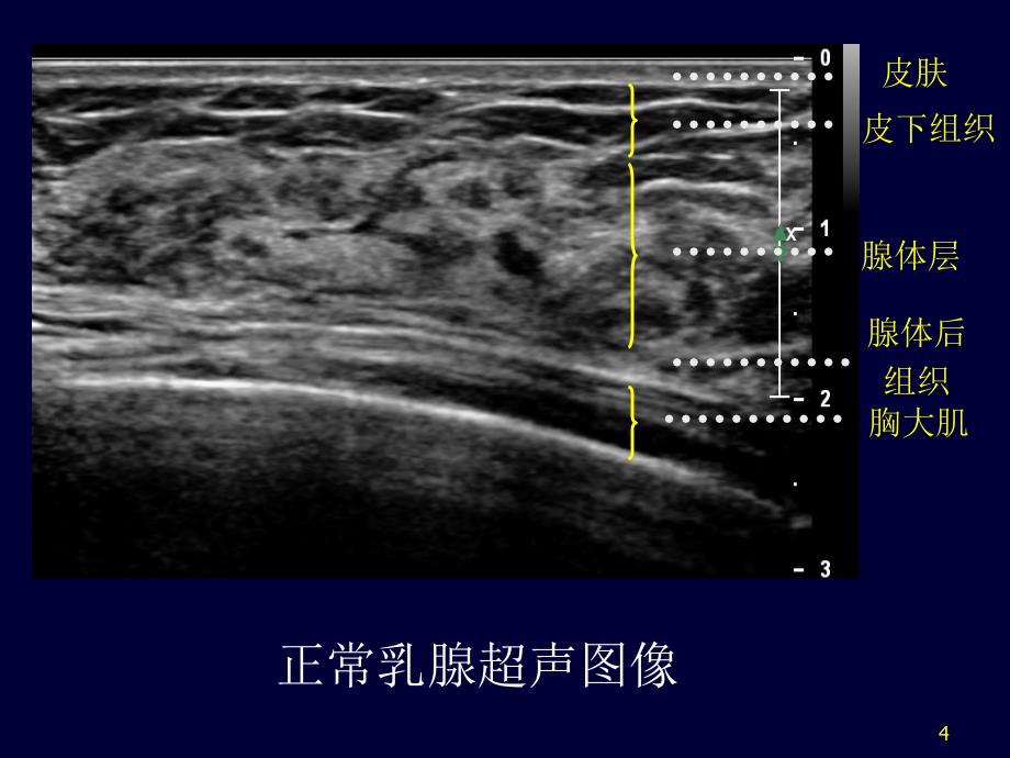 乳腺超声ppt课件_第4页