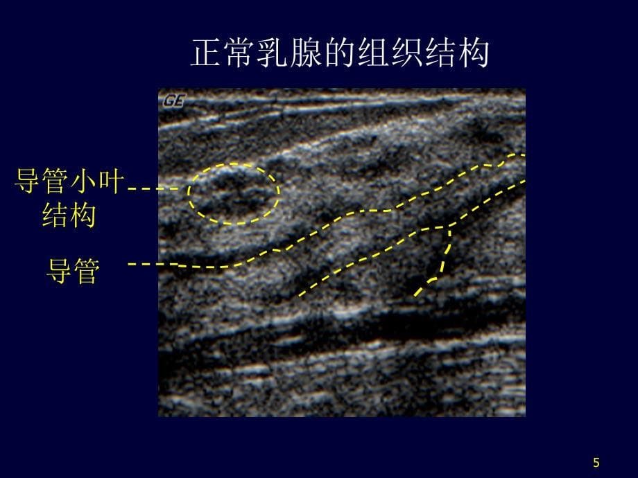 乳腺超声ppt课件_第5页