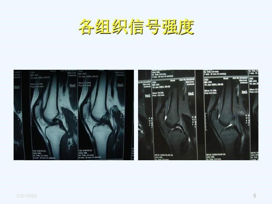 膝关节的核磁共振检查_第5页