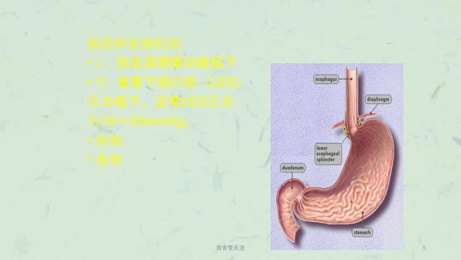 胃食管反流课件_第5页