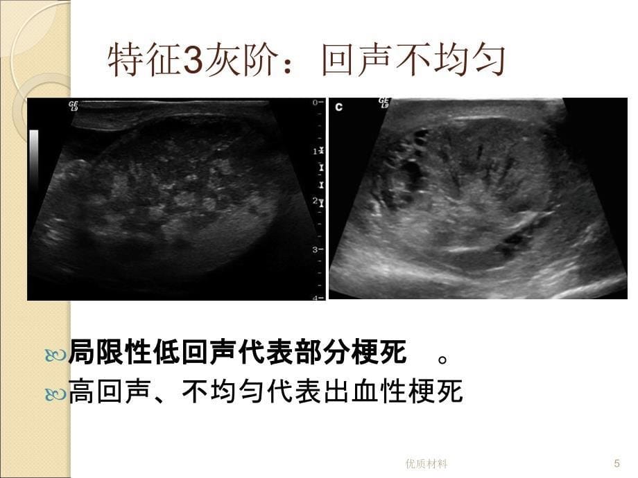 睾丸扭转超声优质借鉴_第5页