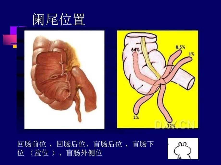 急性阑尾炎的超声诊断_第5页