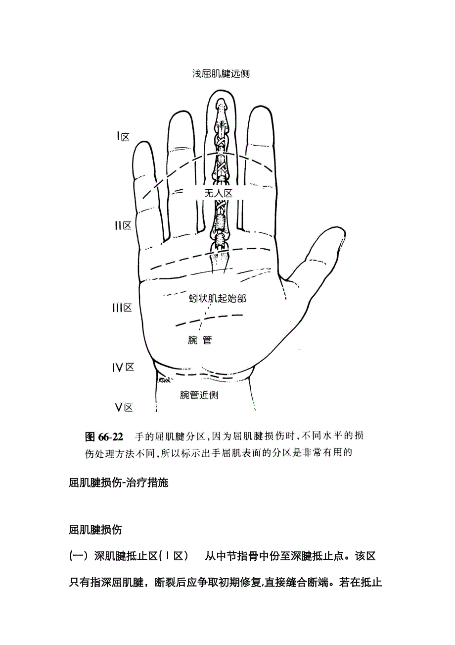 手屈肌腱分区及处理_第1页