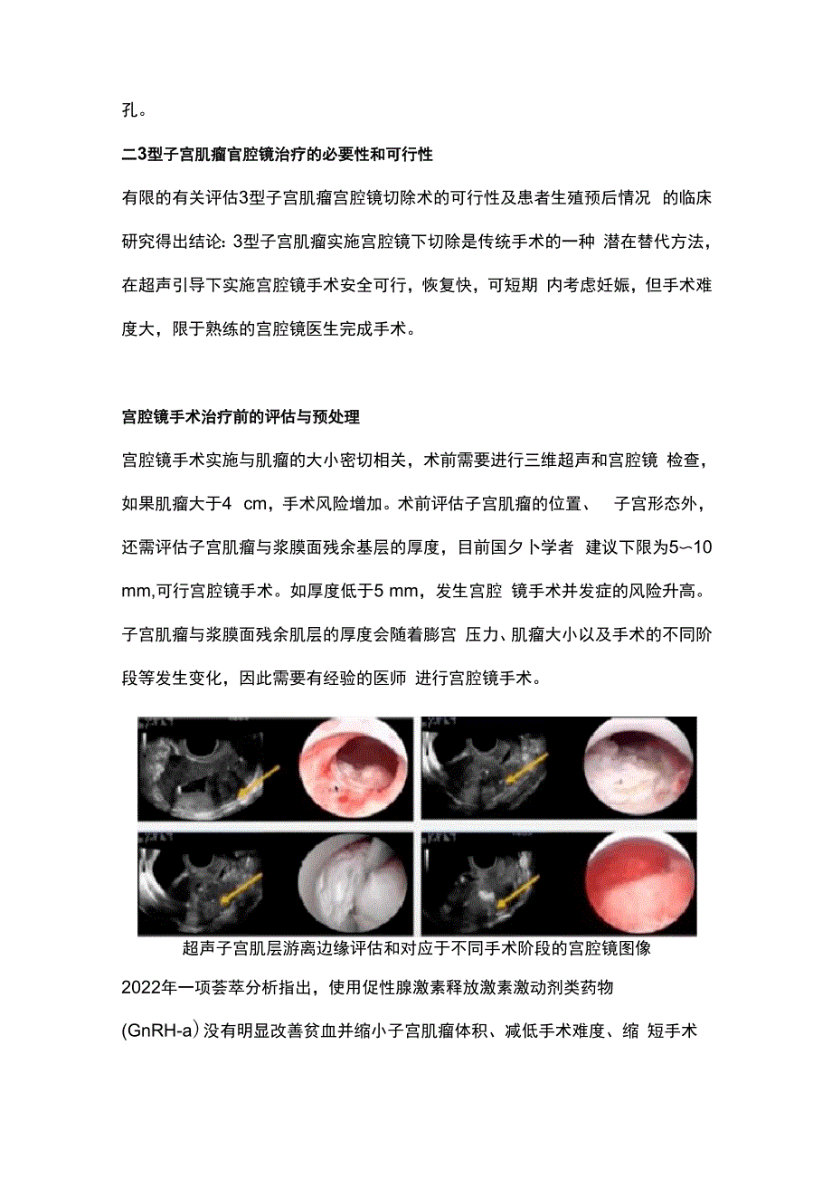 最新：3型子宫肌瘤宫腔镜下切除_第2页