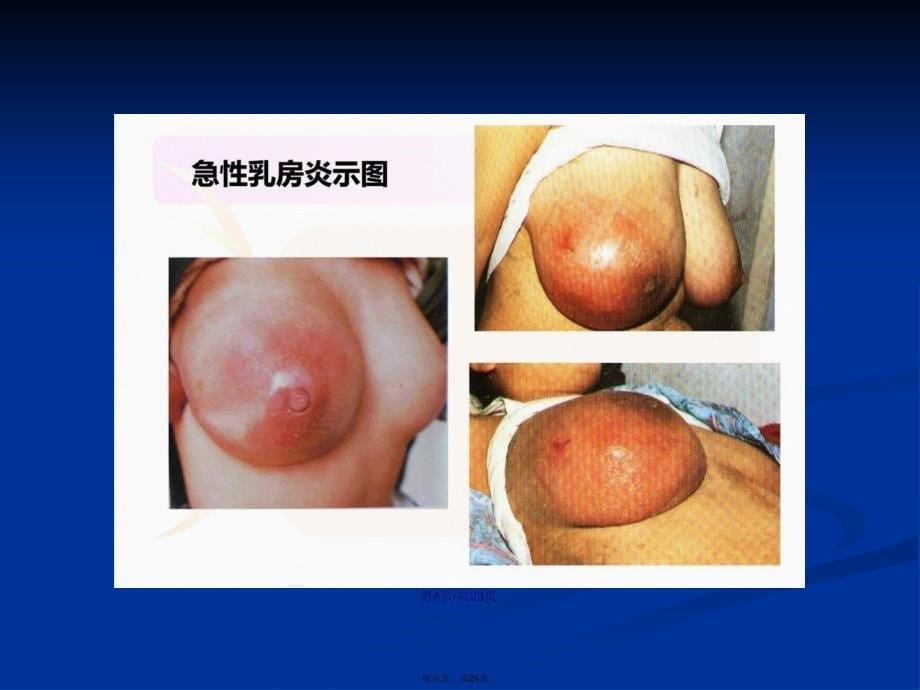 急性乳腺炎护理学习教案_第5页