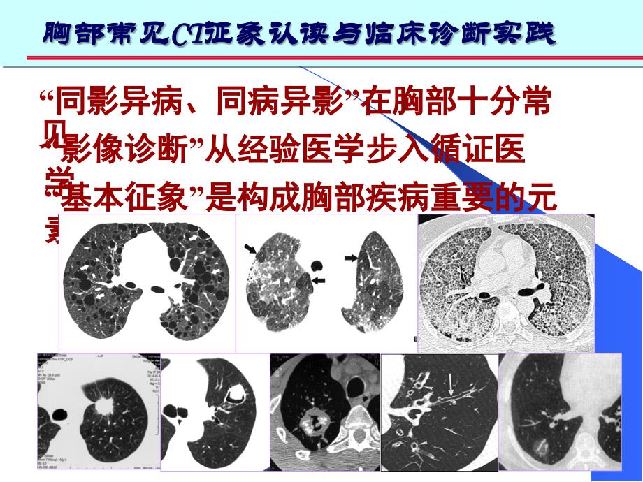 肺部CT十大征象课件_第2页