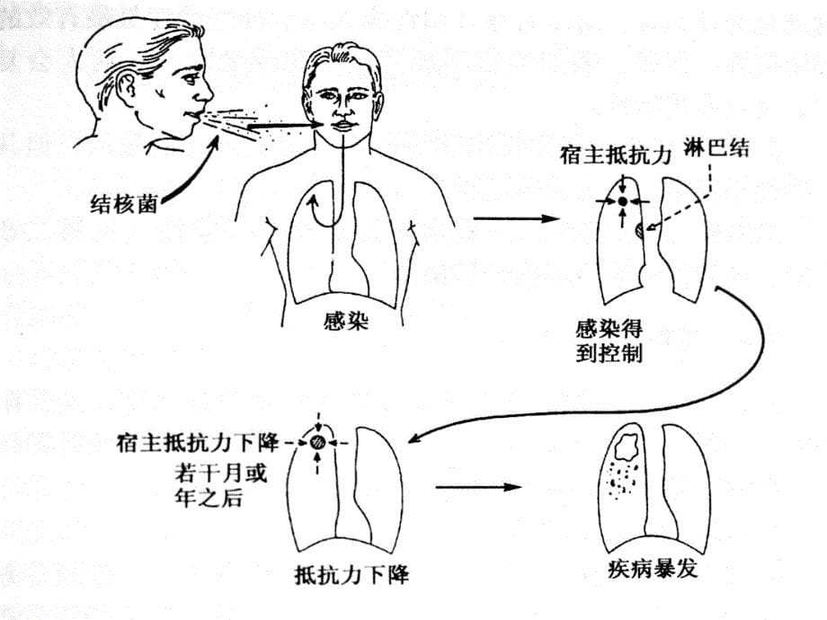 学校结核病防治知识课件_第5页