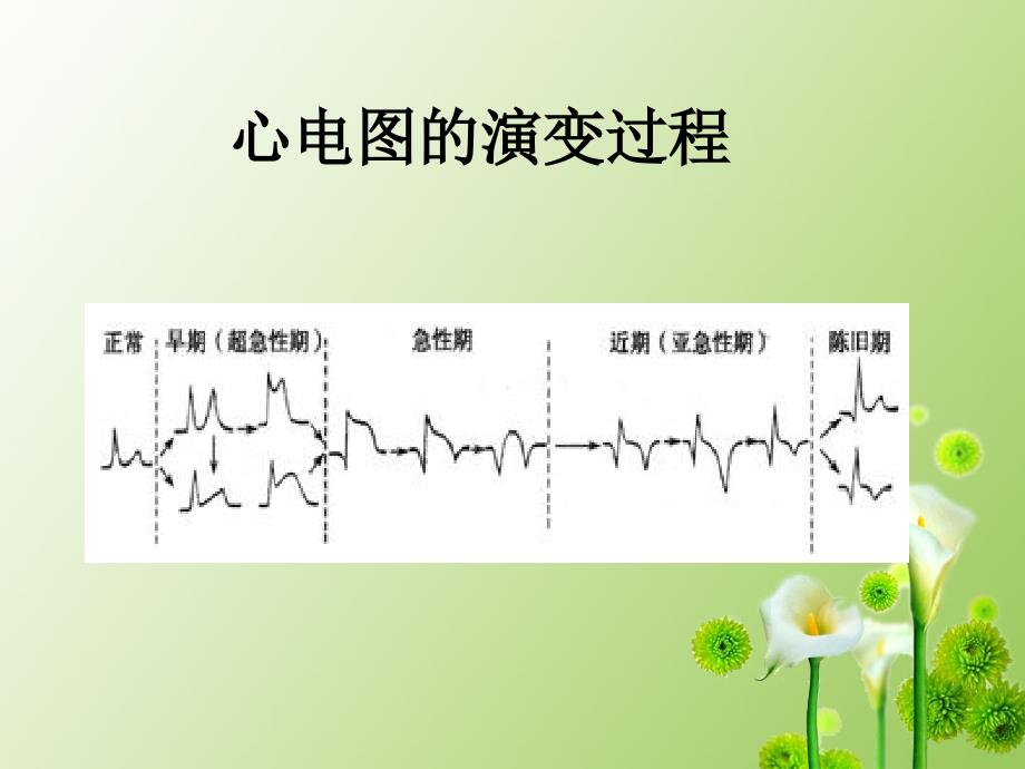 心肌梗死康复护理确定版.ppt_第4页