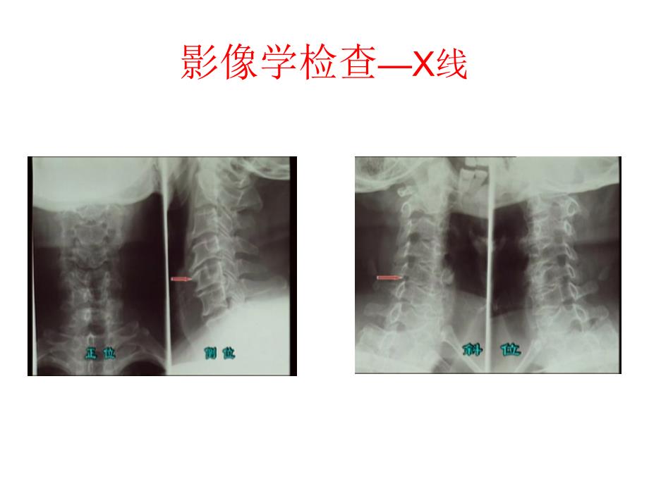 颈椎病的诊断与治疗_第2页