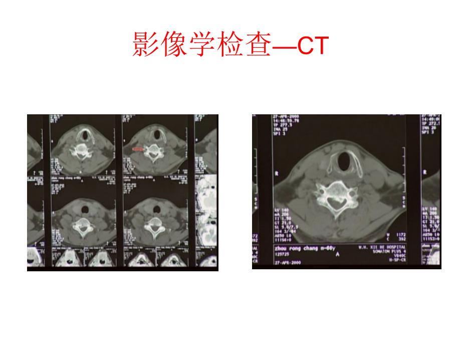 颈椎病的诊断与治疗_第3页