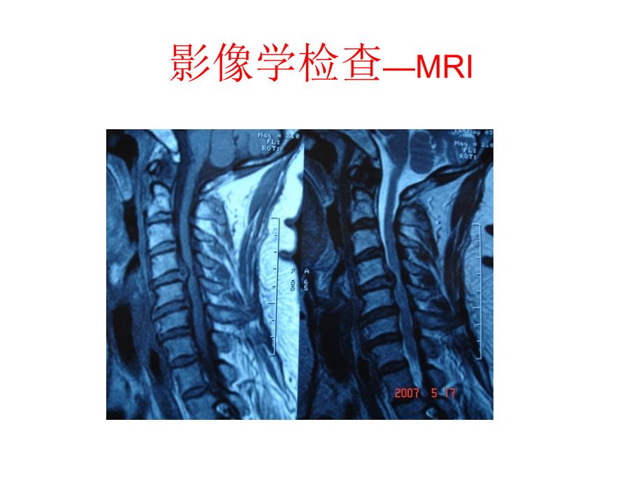 颈椎病的诊断与治疗_第4页