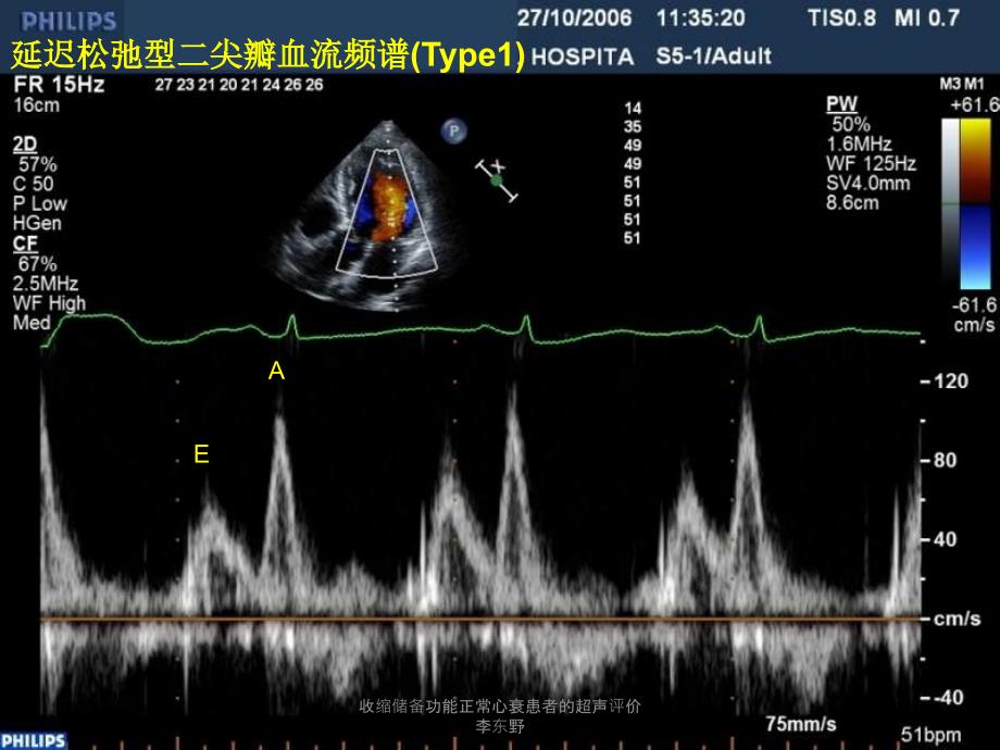 收缩储备功能正常心衰患者的超声评价李东野课件_第3页