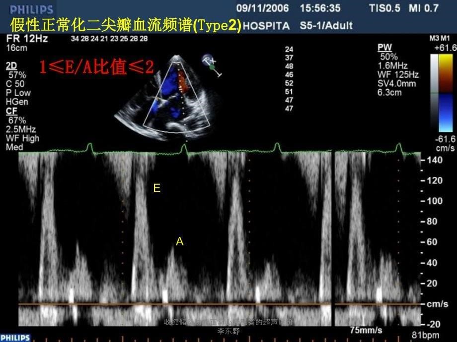 收缩储备功能正常心衰患者的超声评价李东野课件_第5页