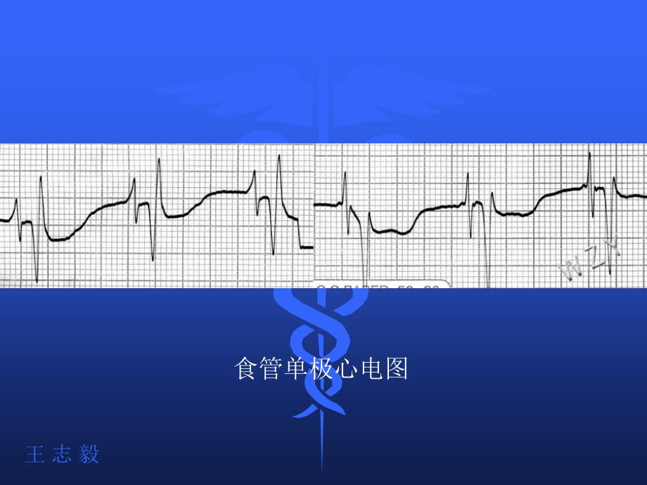 食管心电图临床应用_第4页