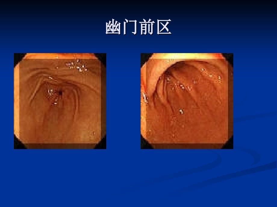 胃镜图谱正常和常见胃病图谱36张.ppt_第5页