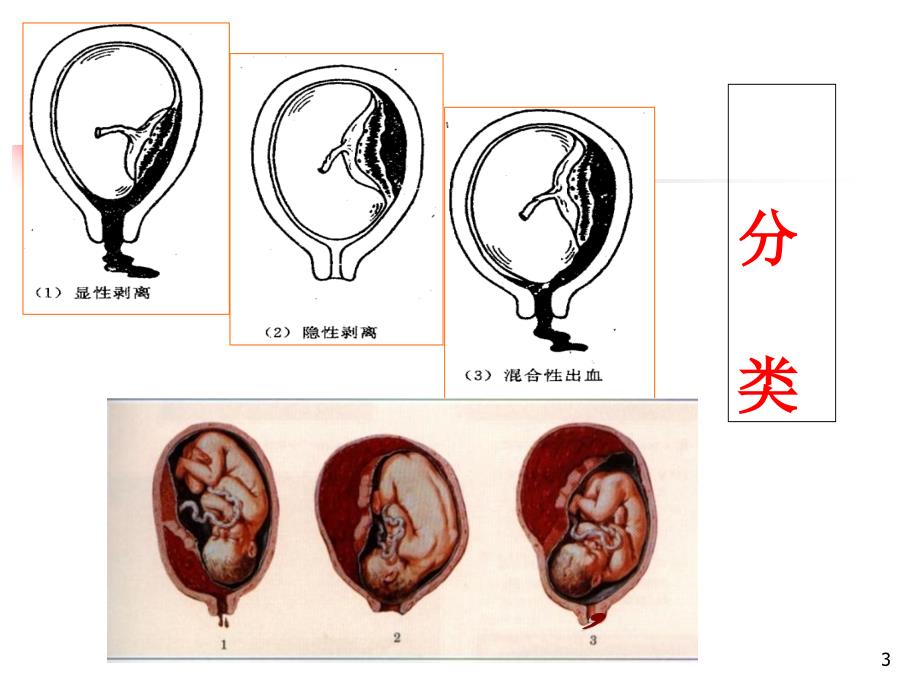 胎盘早剥-PPT课件_第3页