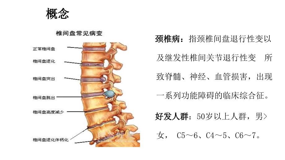 颈椎病的护理查房_第2页