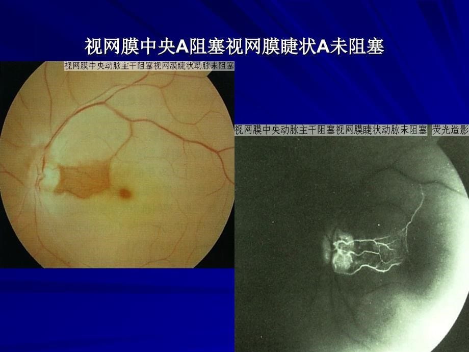 眼底病图谱1电子教案_第5页