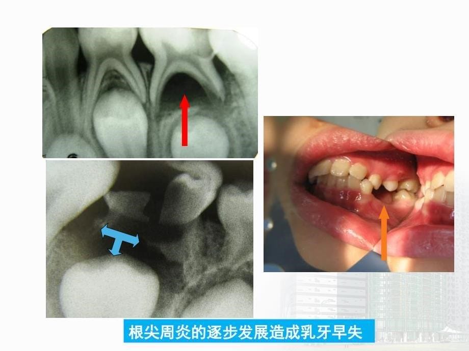 儿童牙髓病和根尖周病_第5页