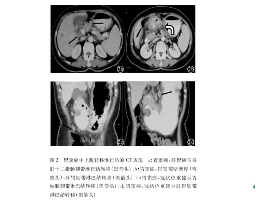 腹膜后淋巴结病变影像ppt课件_第4页