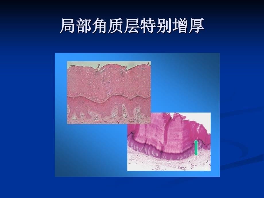 皮肤组织病理的基本变化PPT课件_第5页