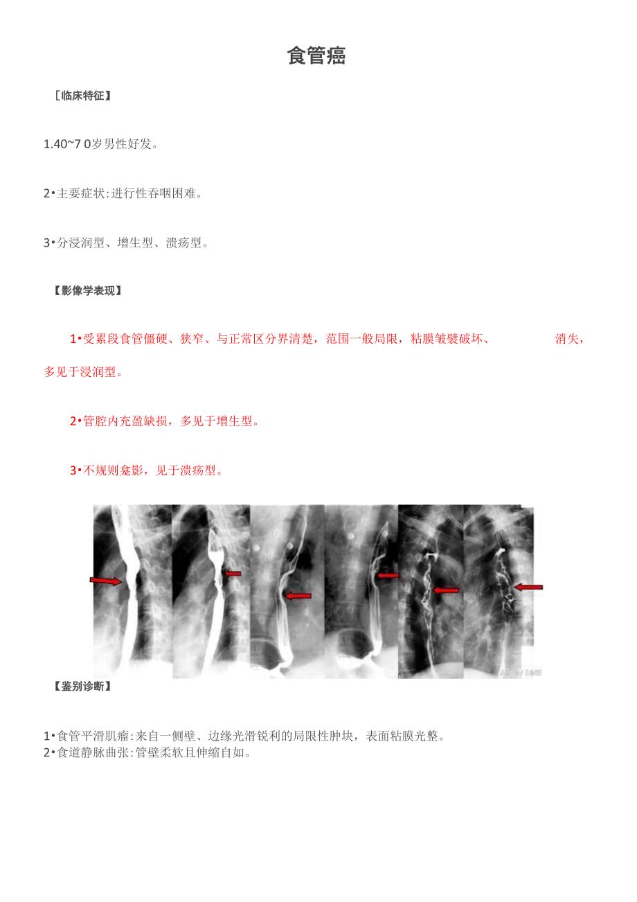 食管癌典型影像学表现及鉴别诊断_第1页