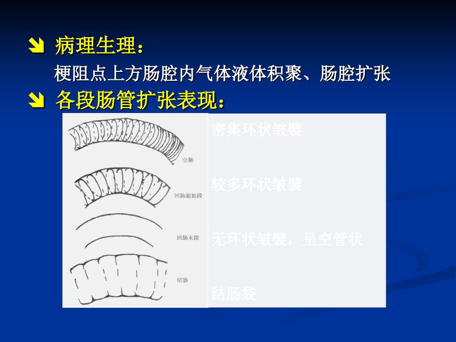 肠梗阻的分类及影像学表现.ppt_第4页