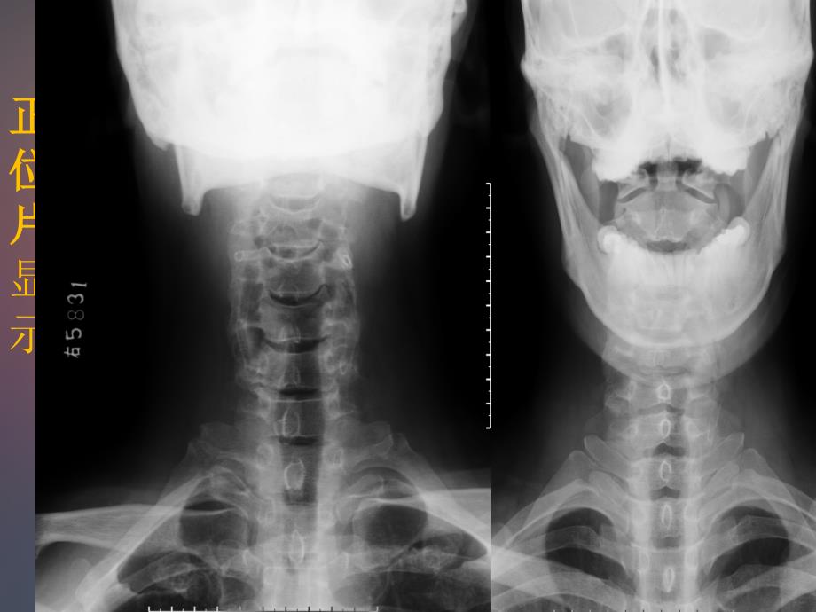 颈椎相关X线读片课件_第3页