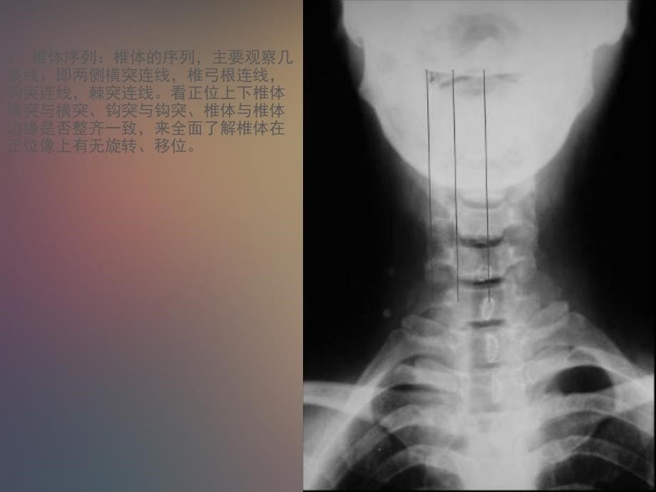 颈椎相关X线读片课件_第5页