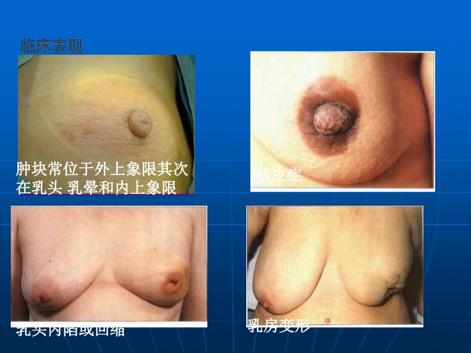 乳腺癌改良根治术护理配合2_第4页