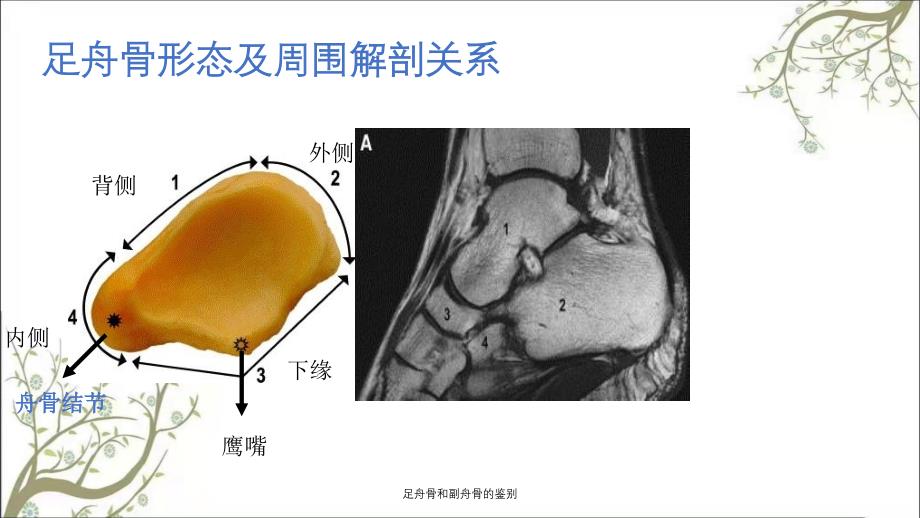 足舟骨和副舟骨的鉴别_第2页