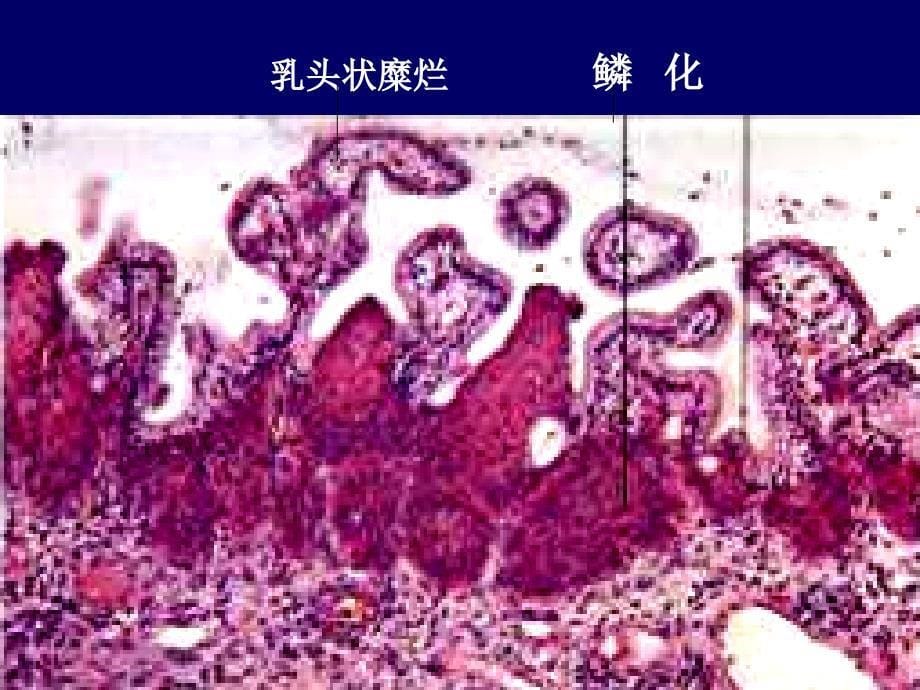 病理学9章女性生殖系统及乳腺疾病_第5页