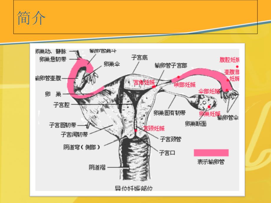 输卵管异位妊娠1课件_第4页