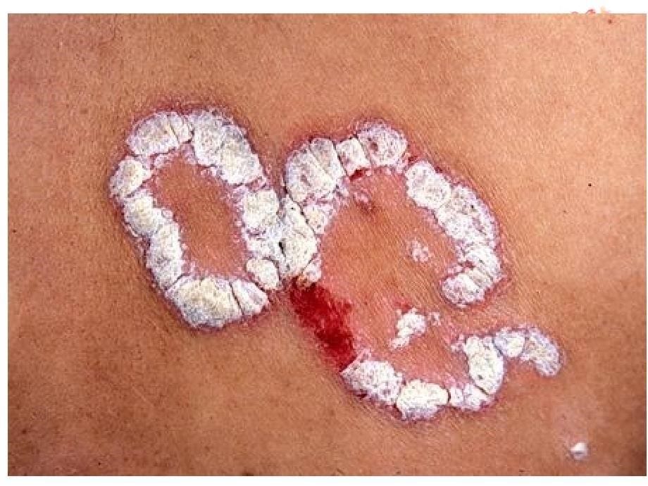 银屑病Psoriasis_第5页