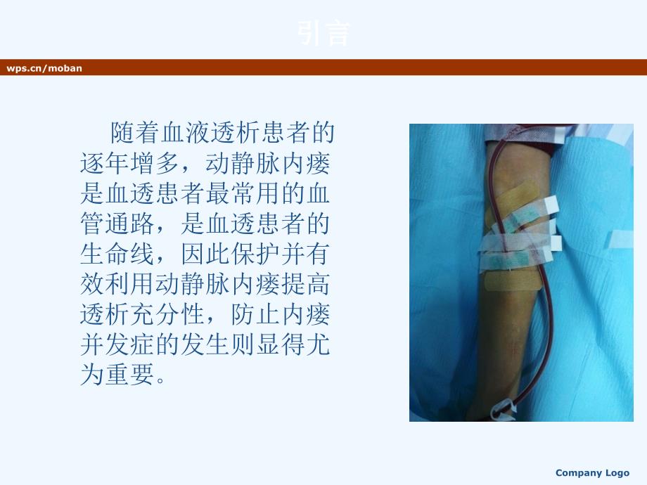 动静脉内瘘穿刺与护理课件_第2页