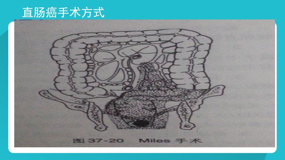 直肠癌麦氏术后护理 (2)_第5页