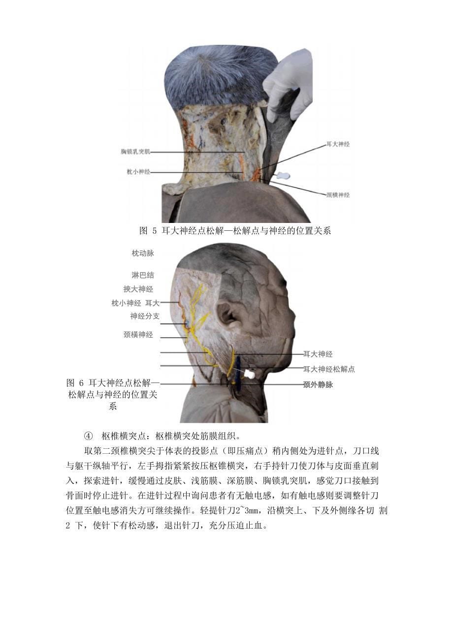 头痛(颈源性头痛)中医诊疗方案_第5页