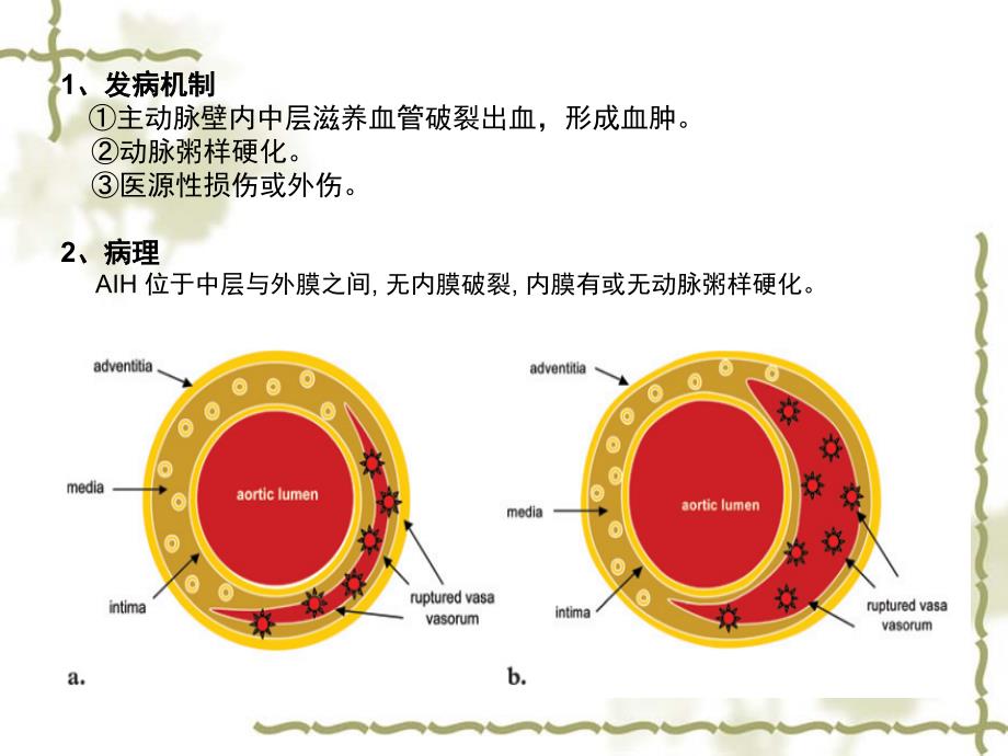 壁内血肿演变及CT表现_第4页