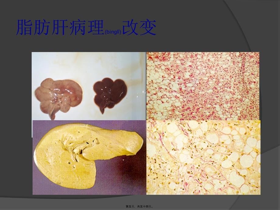 医学专题—脂肪肝(科普版)3_第5页