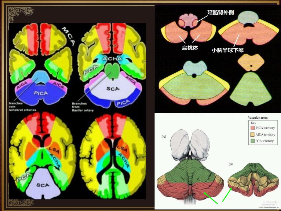 脑血管解剖及脑梗塞定位诊断-小脑后下动脉.ppt_第3页