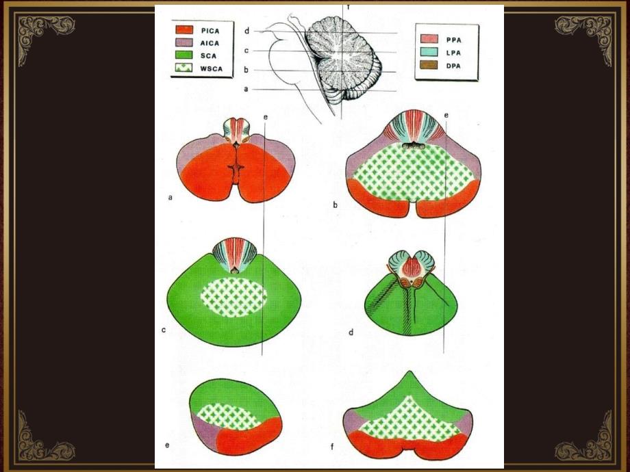 脑血管解剖及脑梗塞定位诊断-小脑后下动脉.ppt_第4页