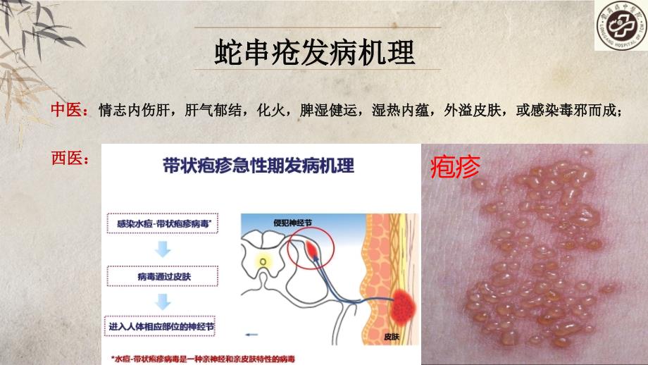 医学课件一例蛇串疮患者个案护理主题讲座课件_第2页