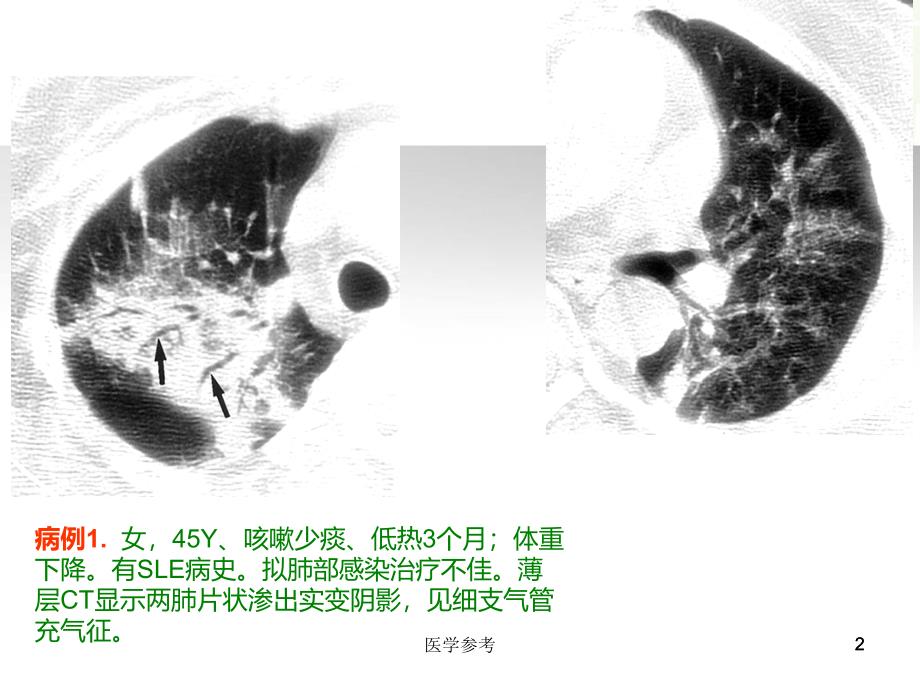 隐源性机化性肺炎的诊断进展[内容充实]_第2页