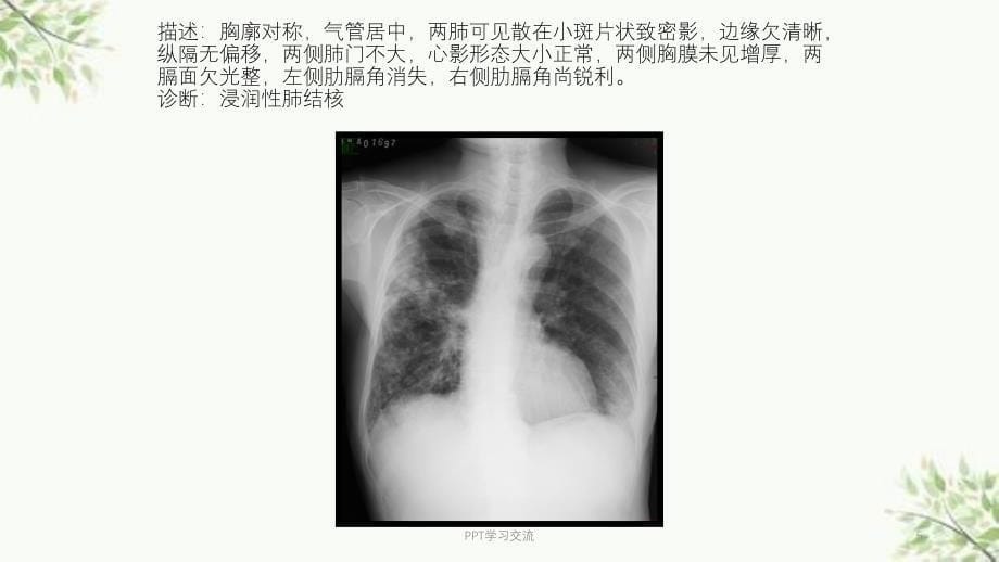 常见X线读片课件_第5页