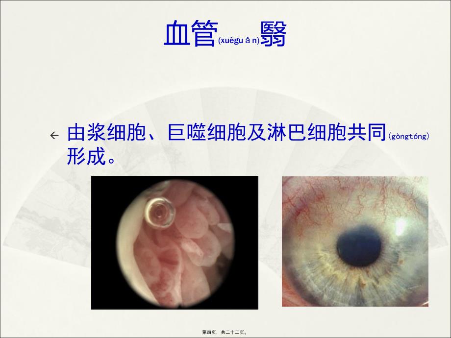 医学专题—强直性脊柱炎综述_第4页