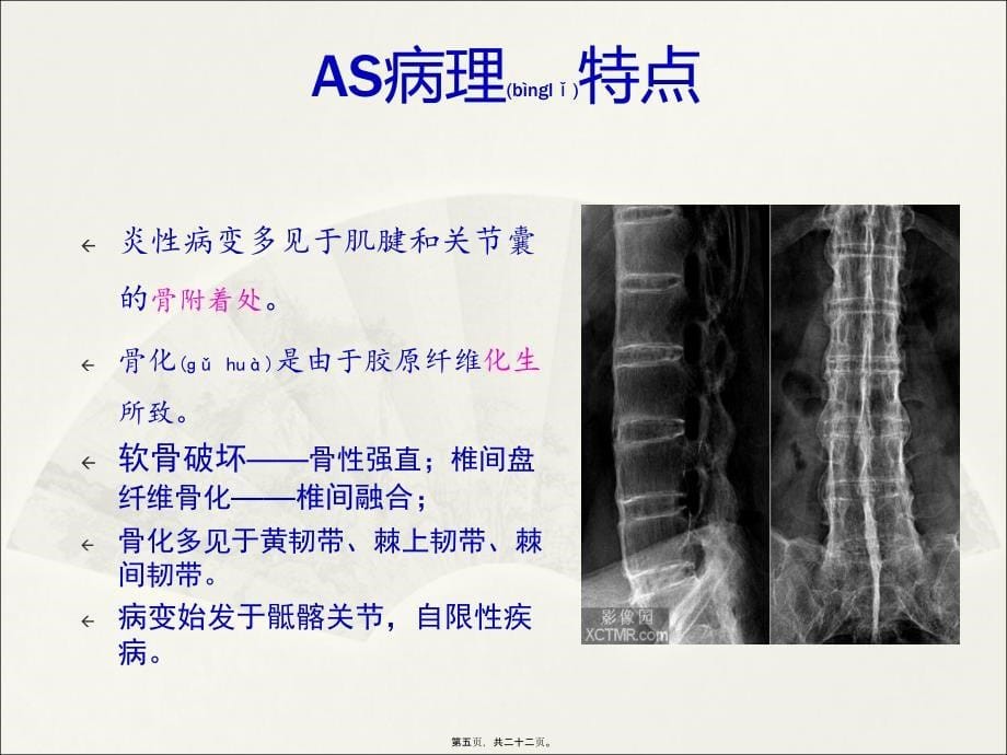 医学专题—强直性脊柱炎综述_第5页